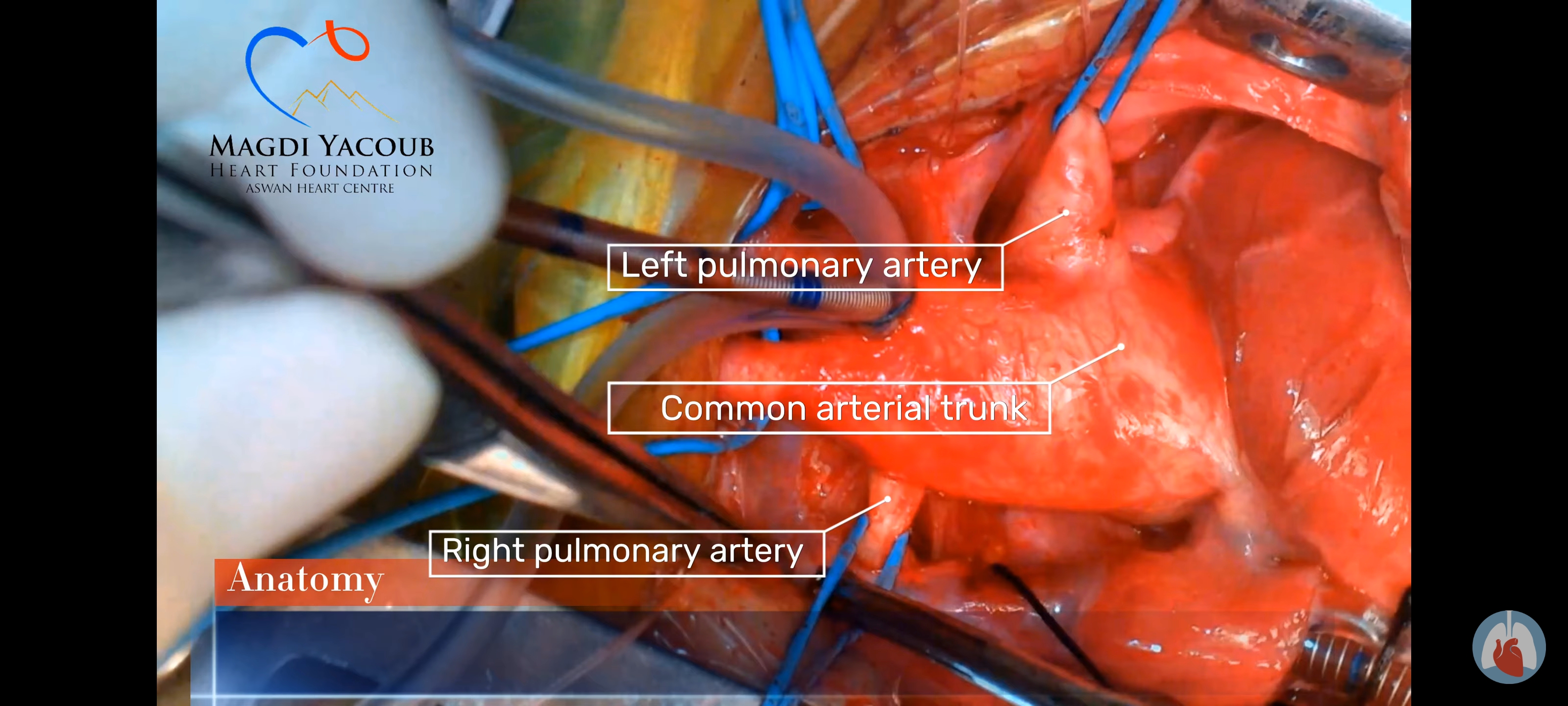 Common Arterial Trunk Type I Repair Using Autologous Arterial Tissue